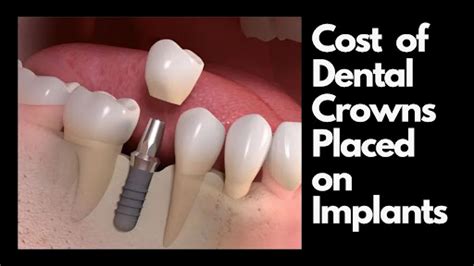 Factors Affecting Dental Crown Cost